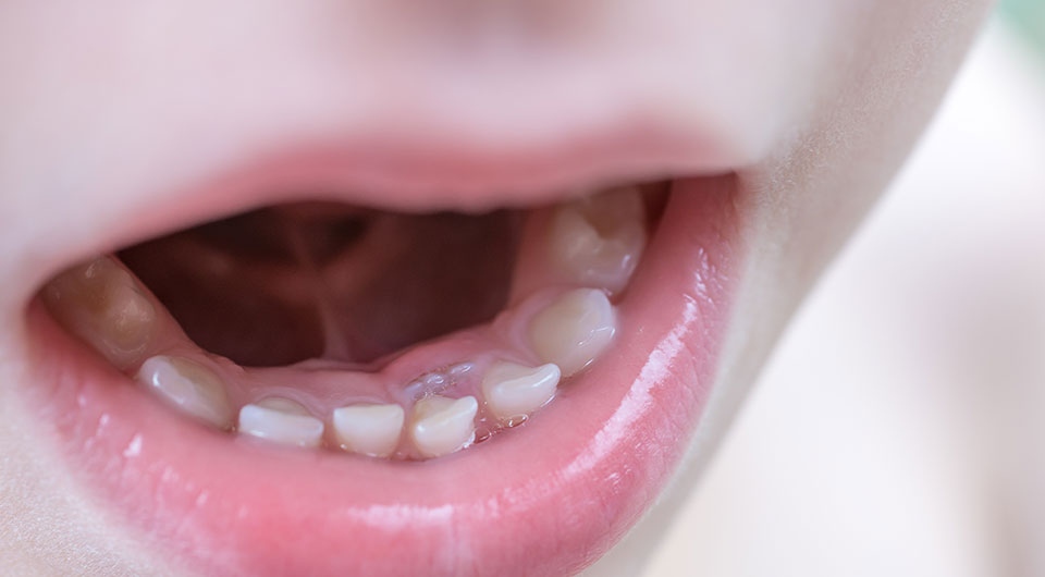 顎骨の成長を利用して、永久歯が生えるスペースを獲得する（歯並びの問題）