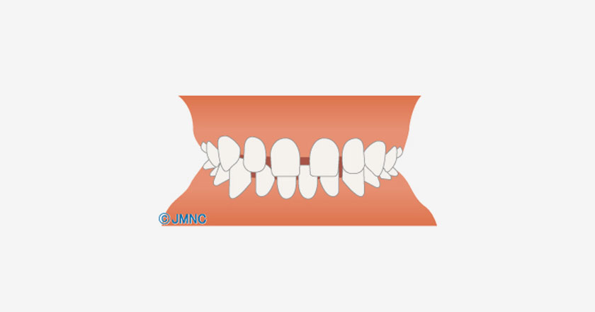 すきっ歯（空隙歯列）