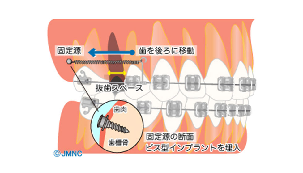 できるだけ歯を抜かない歯科矯正用アンカースクリューを利用した矯正治療